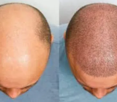 Reclaim Your Confidence with Hair Transplant Treat...