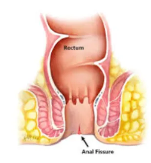 Expert Diagnosis and Treatment for Fissures Fissur...