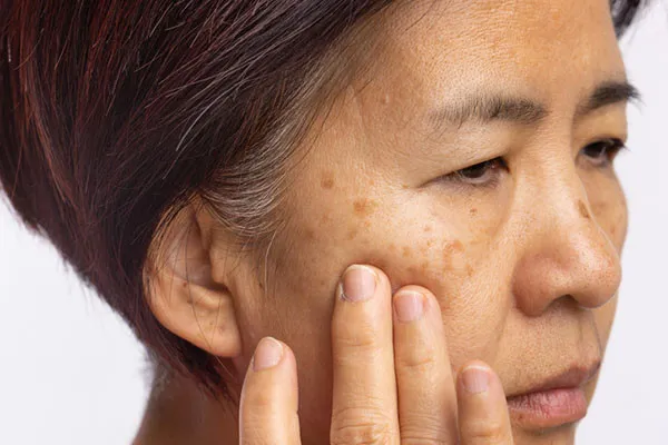 Acne Treatment in West Delhi
Chemical peels are e...