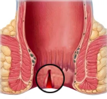 Understanding Fissures: Treatment Options and Prev...
