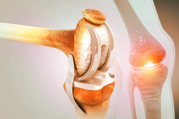 The Art and Science of Joint Replacement: Expert I...