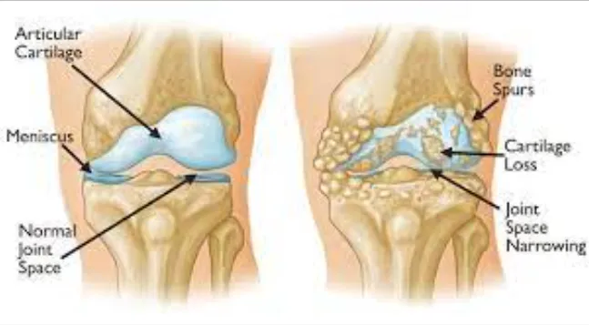 Empowering Patients: Recognizing Early Signs of Jo...