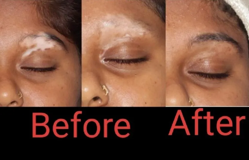 Reclaim Your Confidence with Advanced Vitiligo Tre...
