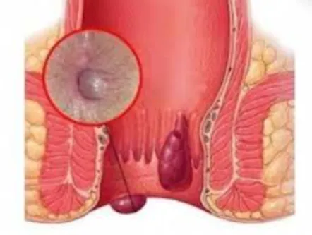 Expert Fissure Treatment at Dr. Phapale Hospital, ...