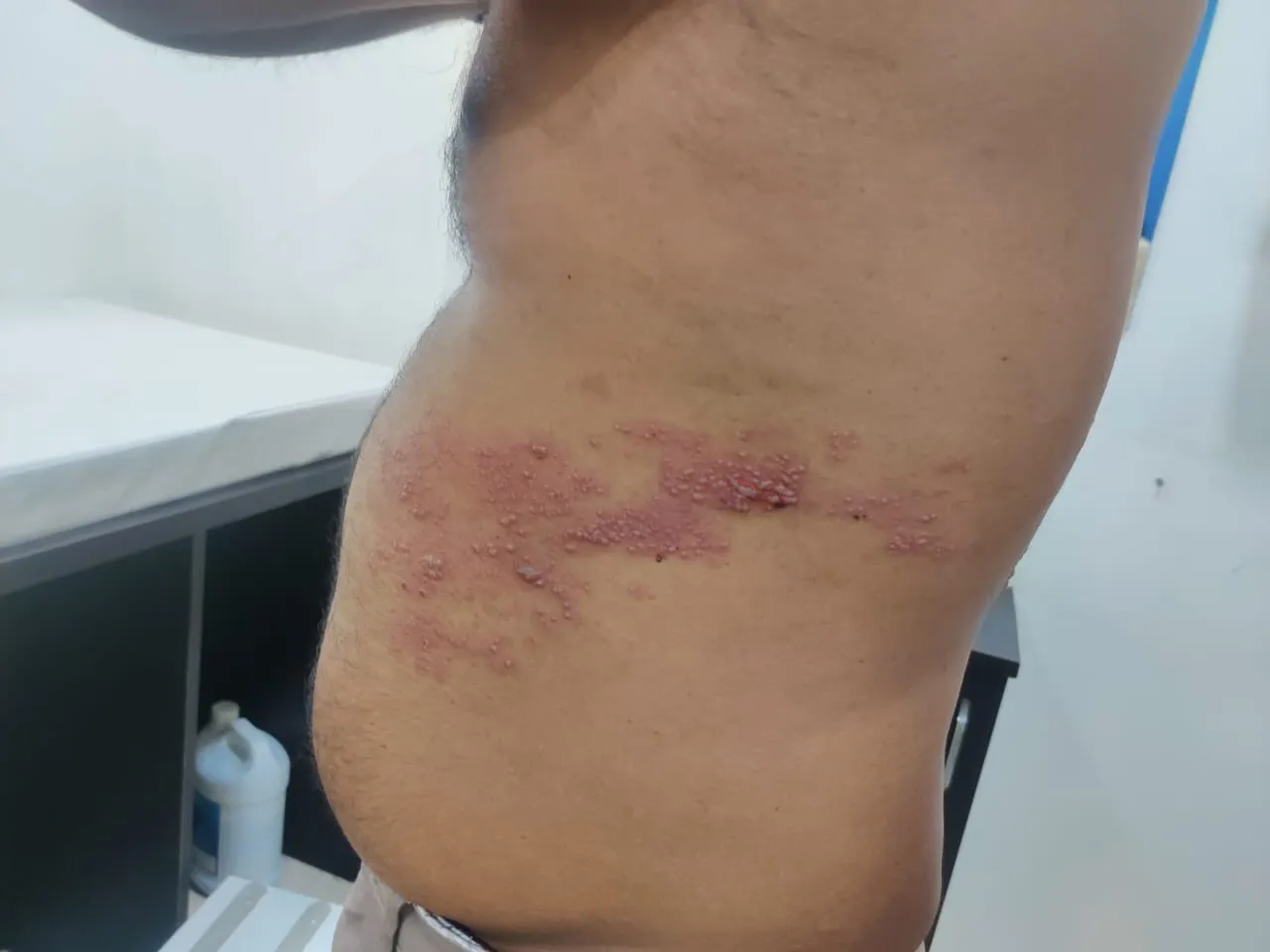 Chronic Pain in Shingles
Postherpetic neuralgia pa...