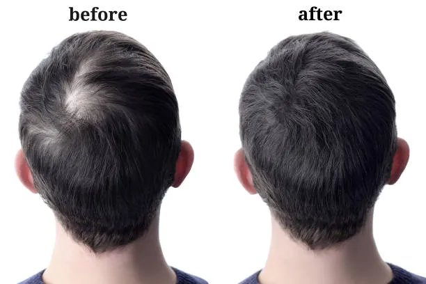 Dealing with hair loss can be a stressful experien...
