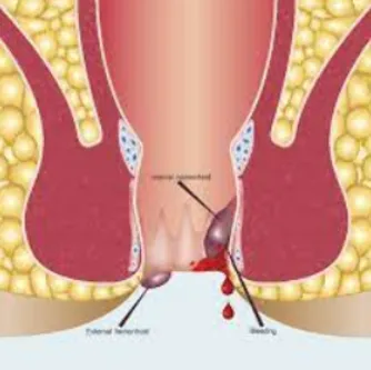 Stay Healthy with Dr. Phapale Hospital's Piles and...