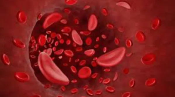 Dr. Atish Bakane: A Beacon of Hope for Sickle Cell...