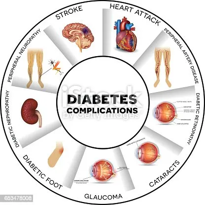 Complications of diabetes, including neuropathy, n...