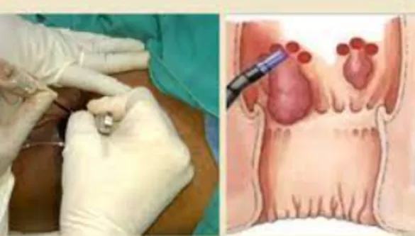 Advanced Laser Surgery for Piles at Dr. Phapale Ho...