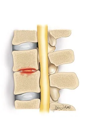 Finding Spine Infection Treatment in Baner? Spine ...