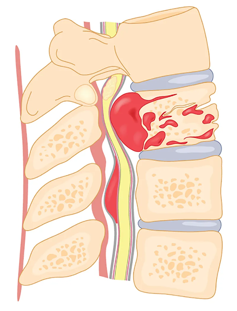 Looking for Spine Tumor Treatment Specialist in Ba...