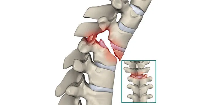 Are you Suffering from Spine Fracture and need to ...