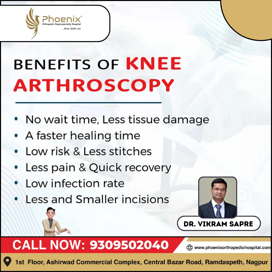 BENEFITS OF KNEE ARTHROSCOPY Consultants At:...