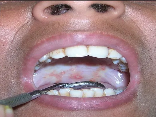 Combat Submucous Fibrosis with Specialized Care at...
