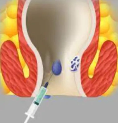 Effective Injection Therapy for Piles at Dr. Phapa...