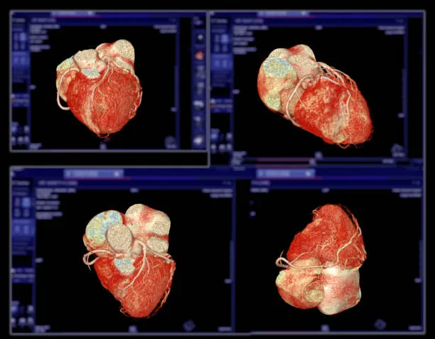 Optimizing Completion Angiography MICS CABG at Dr....