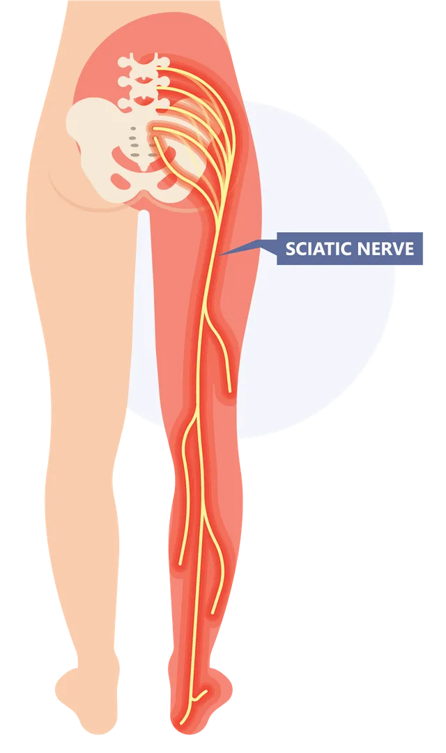 Relief from Sciatica with Homeopathy -- Shree Hom...