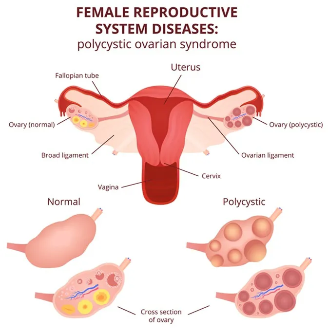 Polycystic Ovary Syndrome - Treatment With Homoeop...