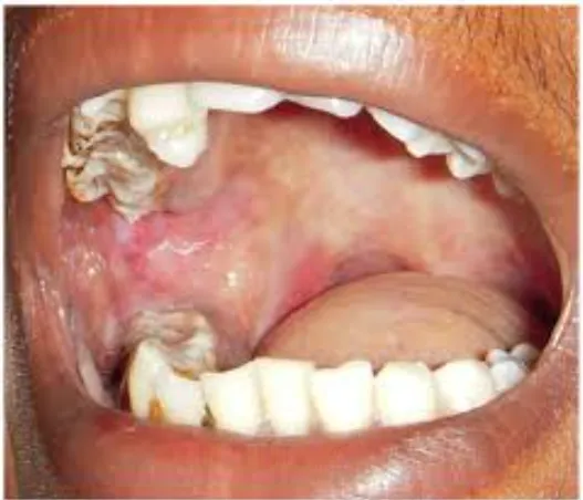 Combatting Submucous Fibrosis: Expert Care at Gind...