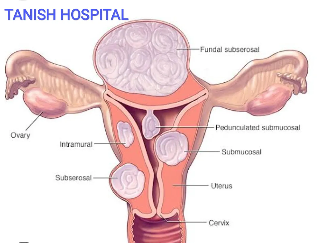 fibroid of uterus can cause pain, bleeding and inf...