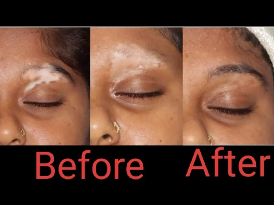Revolutionizing Dermatological Care: Gindodia Hosp...