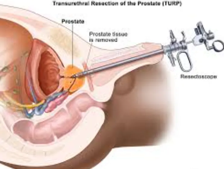 Leading the Way in Prostate Treatment: Dr. Vivek J...
