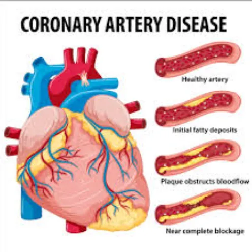 Overcoming Coronary Artery Disease: SR Heart Clini...