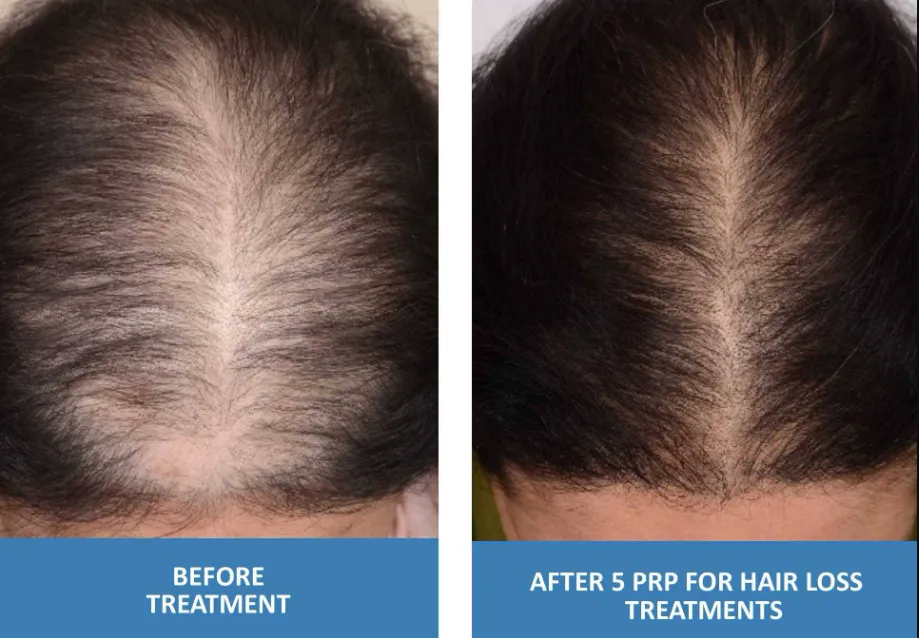 Revitalize Your Mane: PRP Therapy For Hair at TRu ...