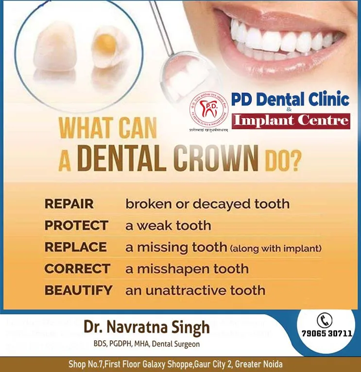 #Dentalcrown
#Pfmcrown
#zirconiacrown
#emaxveneers...