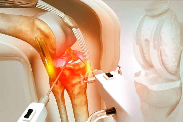 Robotic Knee Replacement: Redefining Orthopedic Su...
