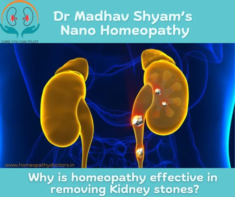 Kidney stones are hard deposits made of minerals a...