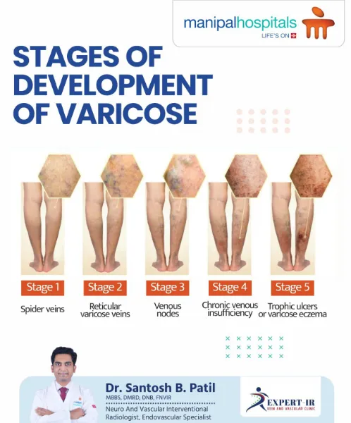 Varicose veins is a slowly progressing disease. It...