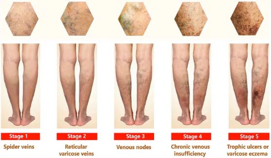 Searching Varicose Veins- VenaSeal and Laser Speci...
