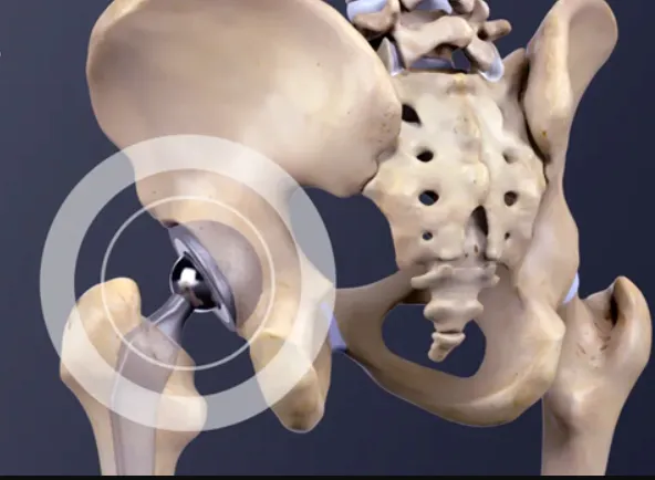 Reclaiming Mobility: The Role of Arthroscopy in Li...
