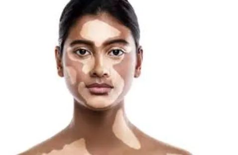 the Mystery of Vitiligo: Gindodia Hospital's Compr...