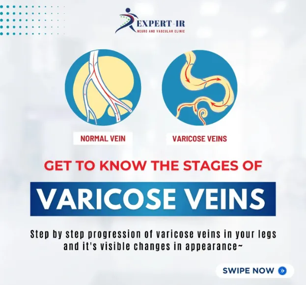 Finding Varicose Vein Specialist in Pune? Varicose...
