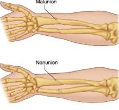 Personalized Nonunion and Malunion Treatment at An...