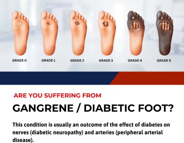 Foot problems are common in people with diabetes. ...