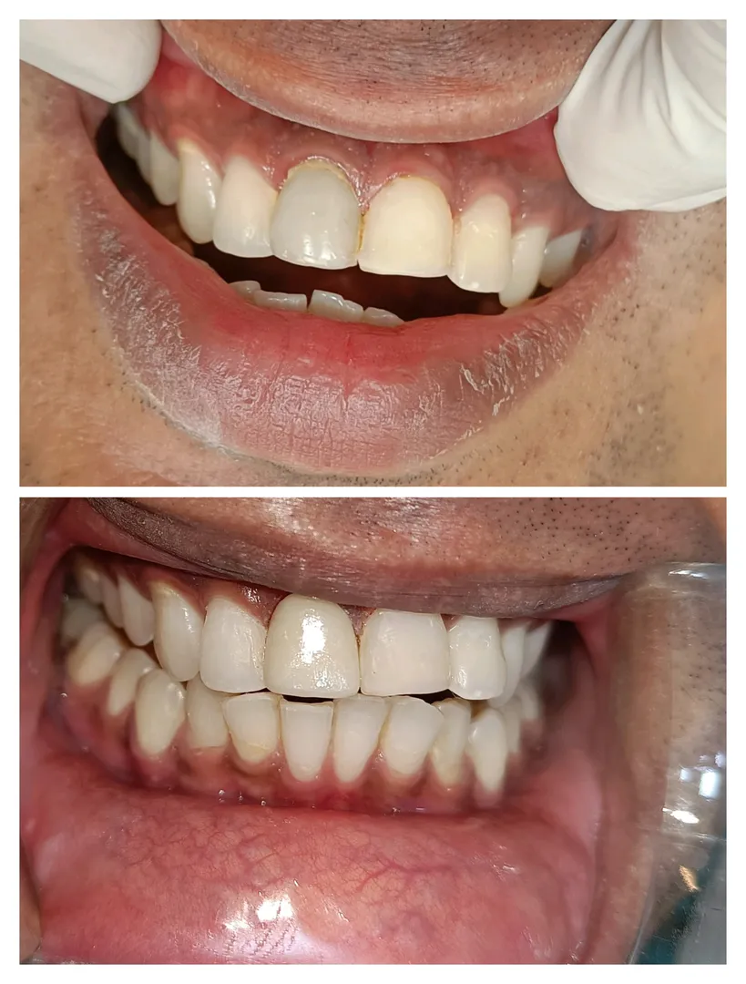 #zirconiacrown
#how to treat a discolored tooth
T...