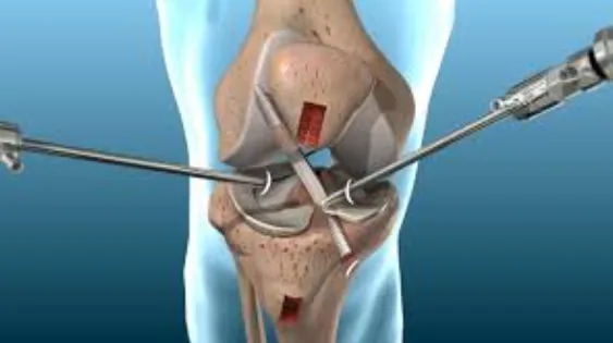 A Closer Look at Ligament Tears: Innovations in Ar...