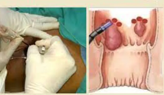 Advancing Care: Laser Treatment for Piles, Fissure...