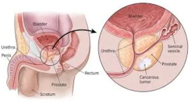 Prostate Health: Expert Care at Your Fingertips in...