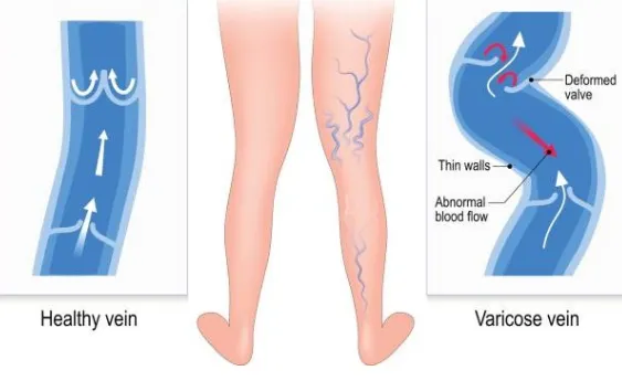 Finding Varicose Veins Specialist in Baner, Aundh,...
