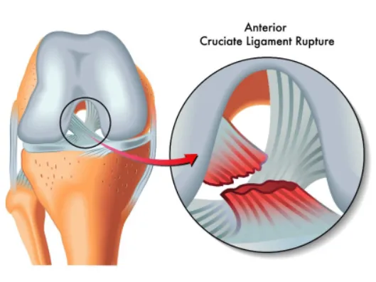 Effective Treatment for ACL Tears by Dr. Rakesh Go...