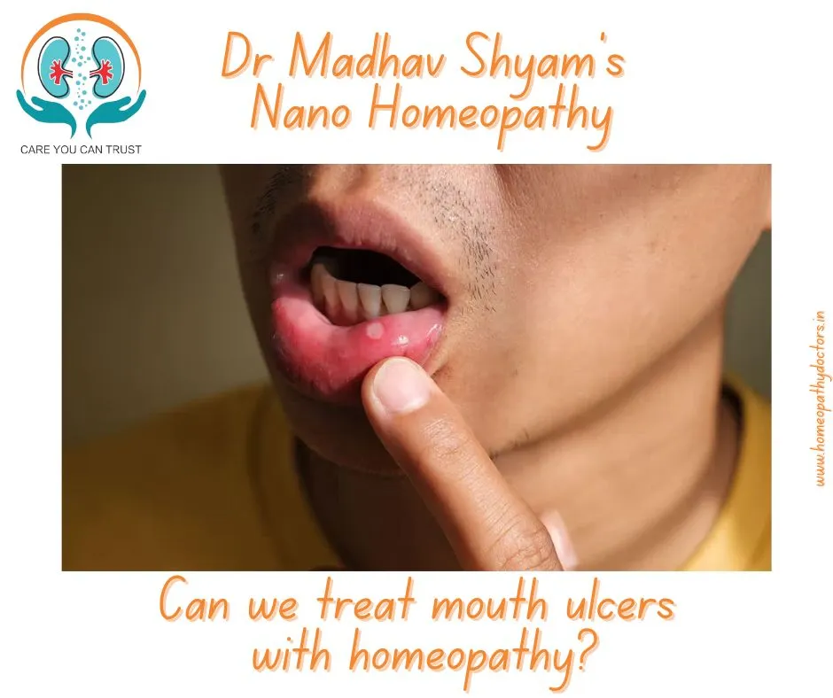 Mouth ulcers, also known as canker sores, are smal...