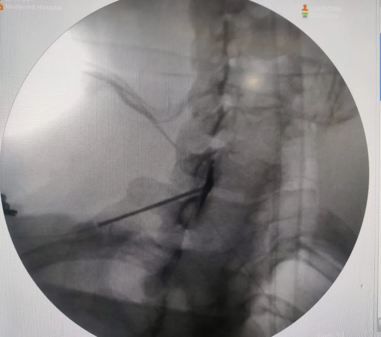 Spine injections, also known as epidural steroid i...