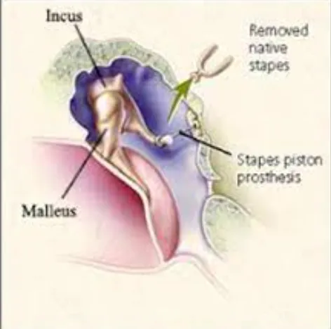 Advanced Ossiculoplasty Techniques: Insights from ...