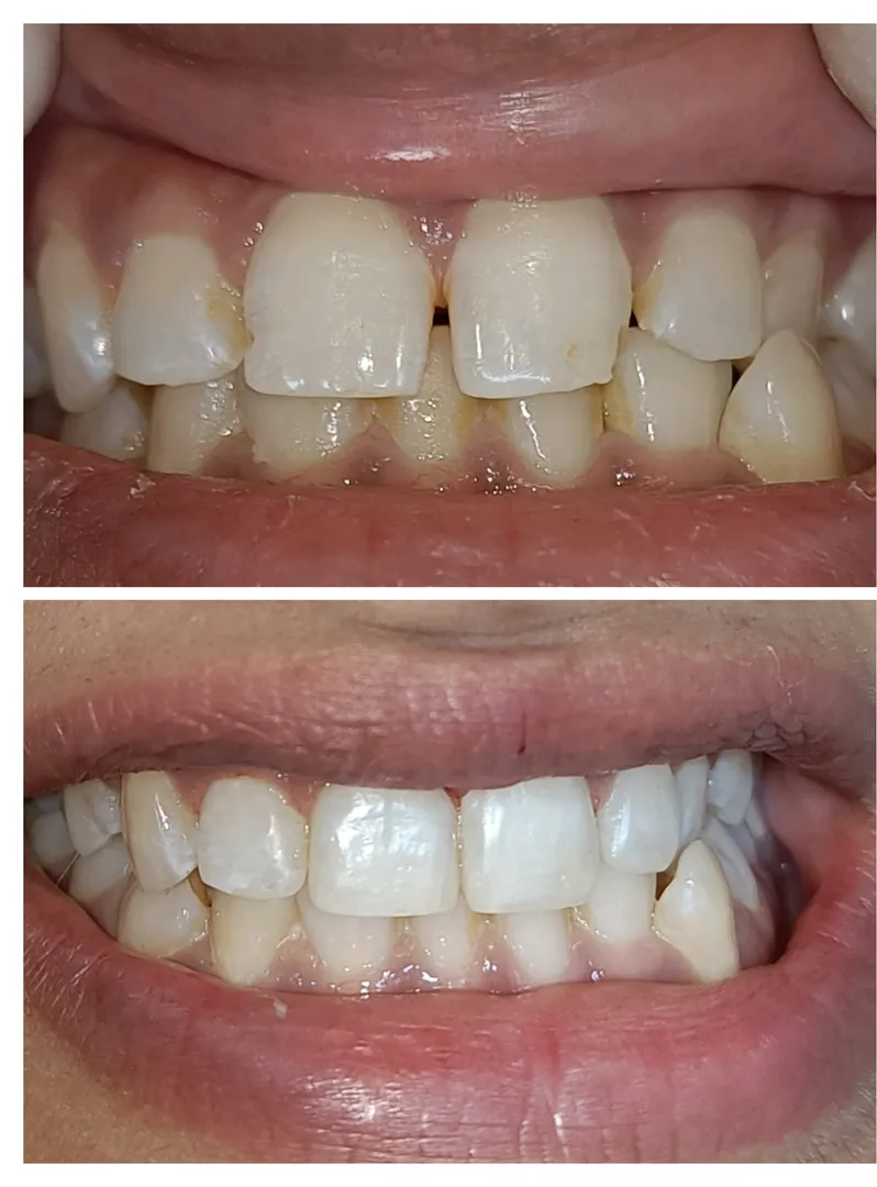 What are the treatment options for a chipped toot...