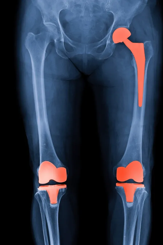 Transforming Lives with Knee Hip Replacement at An...